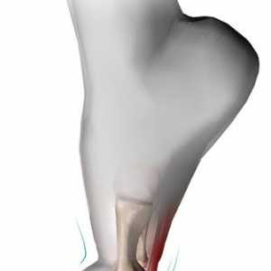 Inflamația articulațiilor degetelor de la picioare: simptome și tratament