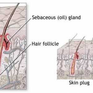 Inflamația becurilor de păr: cauze, simptome, tratament. Prevenirea inflamației becurilor de păr