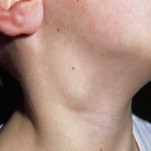 Lymphonoduses pe gât au devenit inflamate. Ce pot face pentru a ușura afecțiunea?