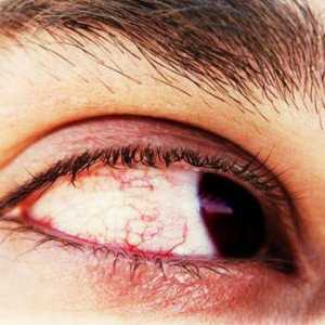 Focare în ochi: cauze, simptome