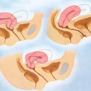 Îndoirea uterului: cauze, simptome, caracteristici de tratament și consecințe