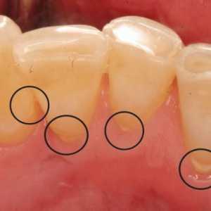 Cavitatea orală sănătoasă: cum să elimini calculii dentare în casă