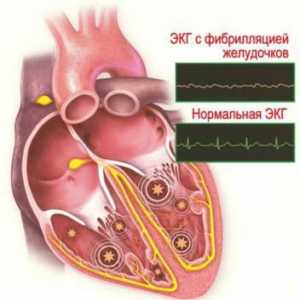 Aritmia ventriculară a inimii: simptome și tratament