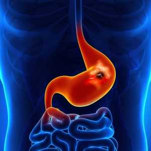 Sângerare gastrointestinală: simptome, diagnostic, îngrijire de urgență