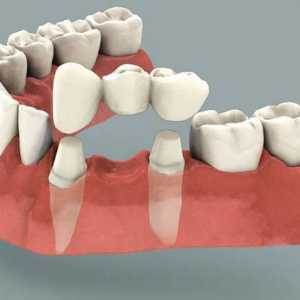 Podul de dinți: recenzii. Instalarea punților dentare