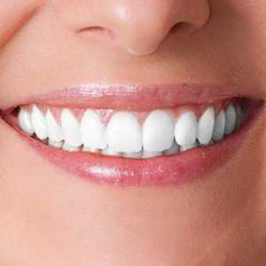 Implanturi dentare: argumente pro și contra. Implanturi dentare: preț, recenzii